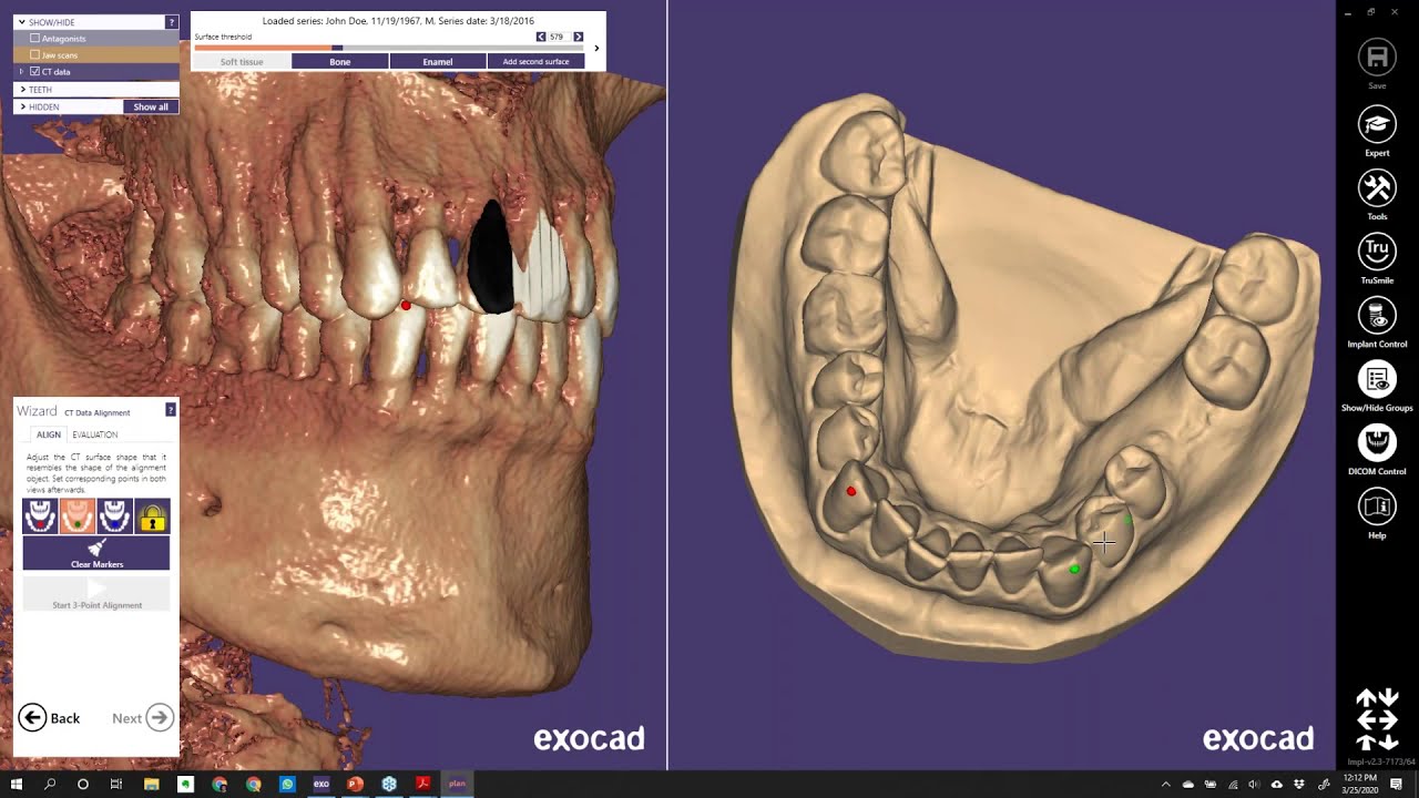 Implant Planning From Start to Finish Using Exoplan Webinar