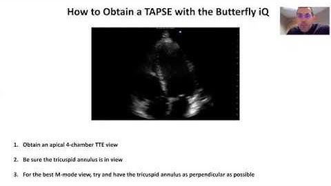 How to Obtain a Tricuspid Annulus Plane Systolic Excursion (TAPSE) with the Butterfly iQ