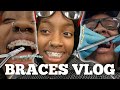 WHATS ITS LIKE GETTING BRACES *COME WITH ME *