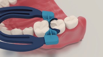 MyClip 2.0 Sectional Matrix System