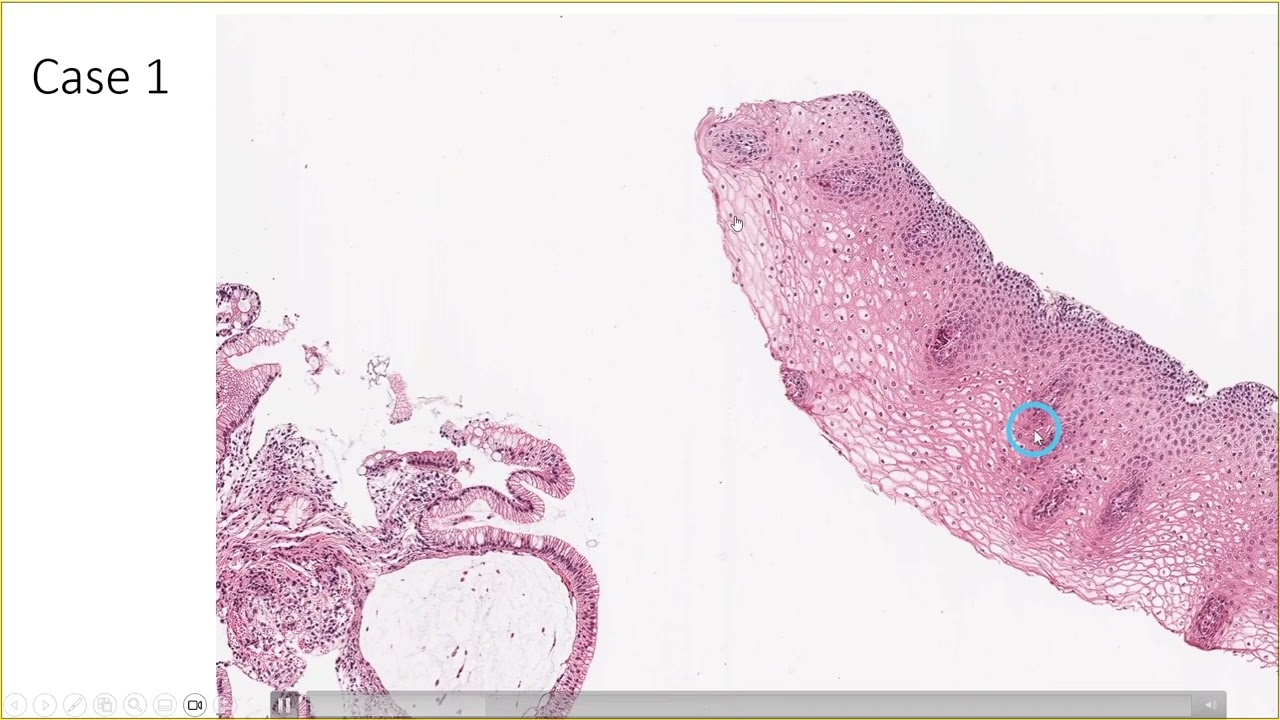 Case (1E): Esophageal Endoscopic Biopsy.... Dx: Barrett's esophagus