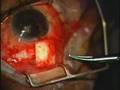 Ahmed valve surgery for glaucoma part4