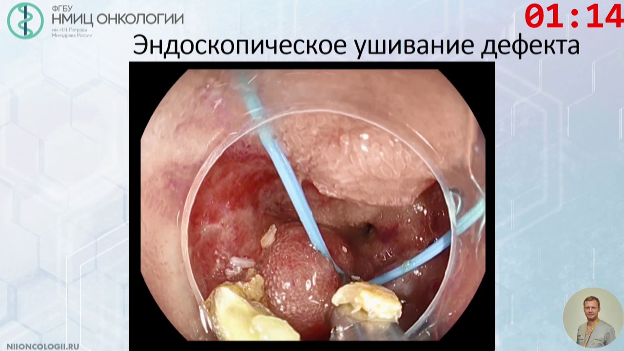 Случай лечения крупной опухоли двенадцатиперстной кишки