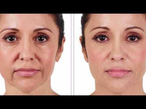 Vídeo: Juvederm Vs Botox: Qual é A Diferença?