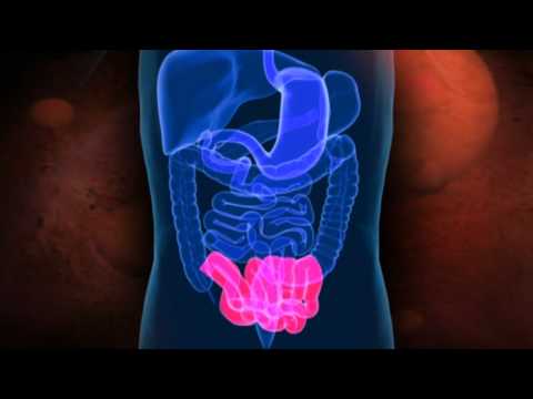 La maladie de Crohns - Connaître votre tube digestif