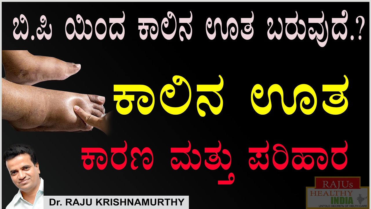 B.P ಯಿಂದ ಕಾಲಿನ ಊತ ಬರುವುದೇ ..?  ಕಾಲಿನ ಊತಕ್ಕೆ ಕಾರಣ ಮತ್ತು ಪರಿಹಾರ