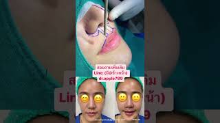 Upper lip lift ผ่าตัดยกริมฝีปากบน หมอเปิ้ล