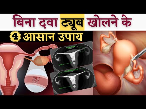 वीडियो: क्या फैलोपियन ट्यूब को जोड़ा जा सकता है?