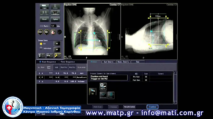 Aquilion ONE, Dynamic Volume Cardiac CT