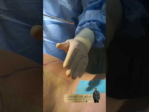 شفط و نحت دهون الظهر و الخواصر