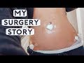 My Surgery Story | Endometriosis