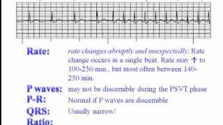 ECG: Paroxysmal Supraventricular Tachycardia (PSVT)