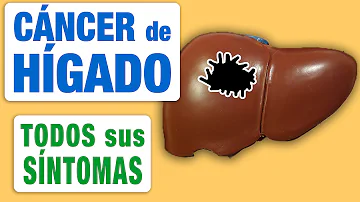 ¿Cuáles son los primeros síntomas del cáncer de hígado?