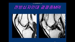 전방십자인대 결절종MRI