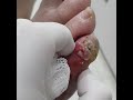 Sekerli xestede barmaqda irinli yara ismail esgerov fleboloq cerrah diabetik ayaq konfransi hekim