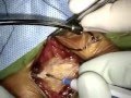 Carotid Endarterectomy Surgeon: Patrick C. Ryan, MD