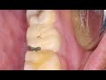 HOW TO MIX DENTAL CEMENTS AND PREVENT CHIPPING OF PFM CROWNS?