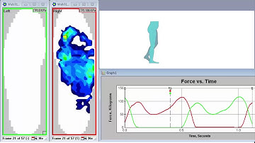 Using F-Scan™ to Evaluate the Gait Cycle