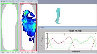 Using F-Scan™ to Evaluate the Gait Cycle