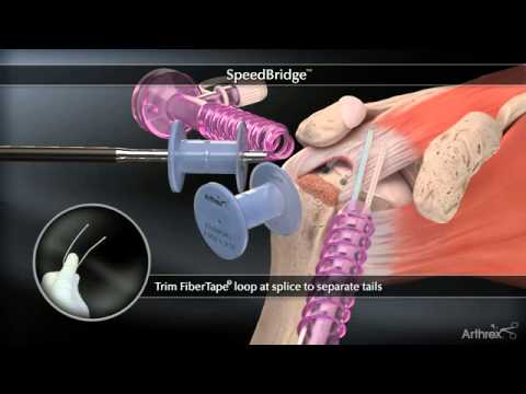 Arthrex SpeedBridge™ - YouTube
