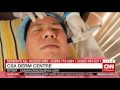 Non-Surgical Cosmetic Procedurers CNN part 2