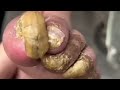 ЁЯШН LONGEST ONYCHOMYCOSIS NAILS CURE тЪбLong Fungus Toenails Removal Pedicure Satisfying Asmr Rain ЁЯШН LONGEST ONYCHOMYCOSIS NAILS CURE тЪбLong Fungus Toenails Removal Pedicure Satisfying Asmr Rain