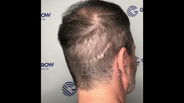 Amazing Scar Camouflage with ScalpMicropigmentation