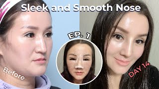 [SUB] Bulbous Nasal Tip Rhinoplasty Nose Job vlog | Korea Plastic Surgery | before and after review