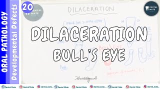 Dilaceration | Bull’s eye appearance | Developmental disturbances in shape of tooth | Dr Paridhi