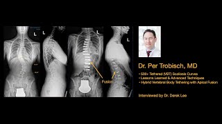 Dr. Per Trobisch, 500 VBT Surgeries Lessons Learned, Hybrid VBT with Apical Fusion Scoliosis Surgery