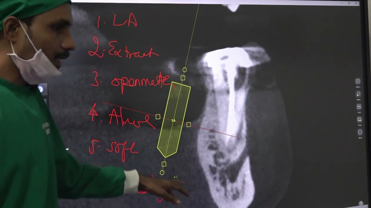 PART - 12 Cortico Basal Dental Implant Course November 2023-Dr.C. Murugavel.