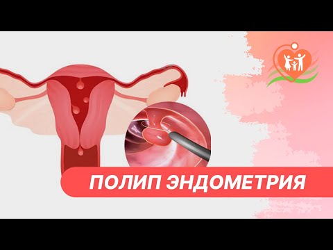 Видео: Пройдут ли полипы?