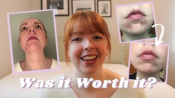 Accutane Experience + Before and After  (Mild to Moderate Acne)