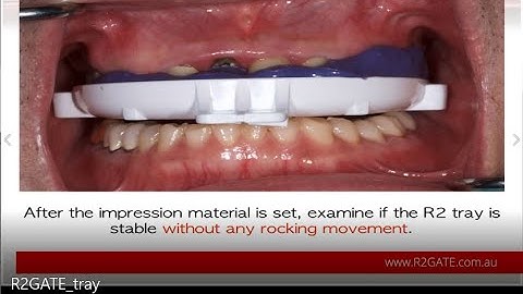 How to prepare for R2Gate surgical guide using R2 tray.