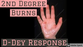 How to deal with 2nd Degree Burns