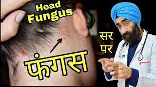 सर से फंगस ख़तम कैसे करे | How to Cure Fungal head, Hair, Beard Infection | Dr.Education (Hindi) screenshot 4