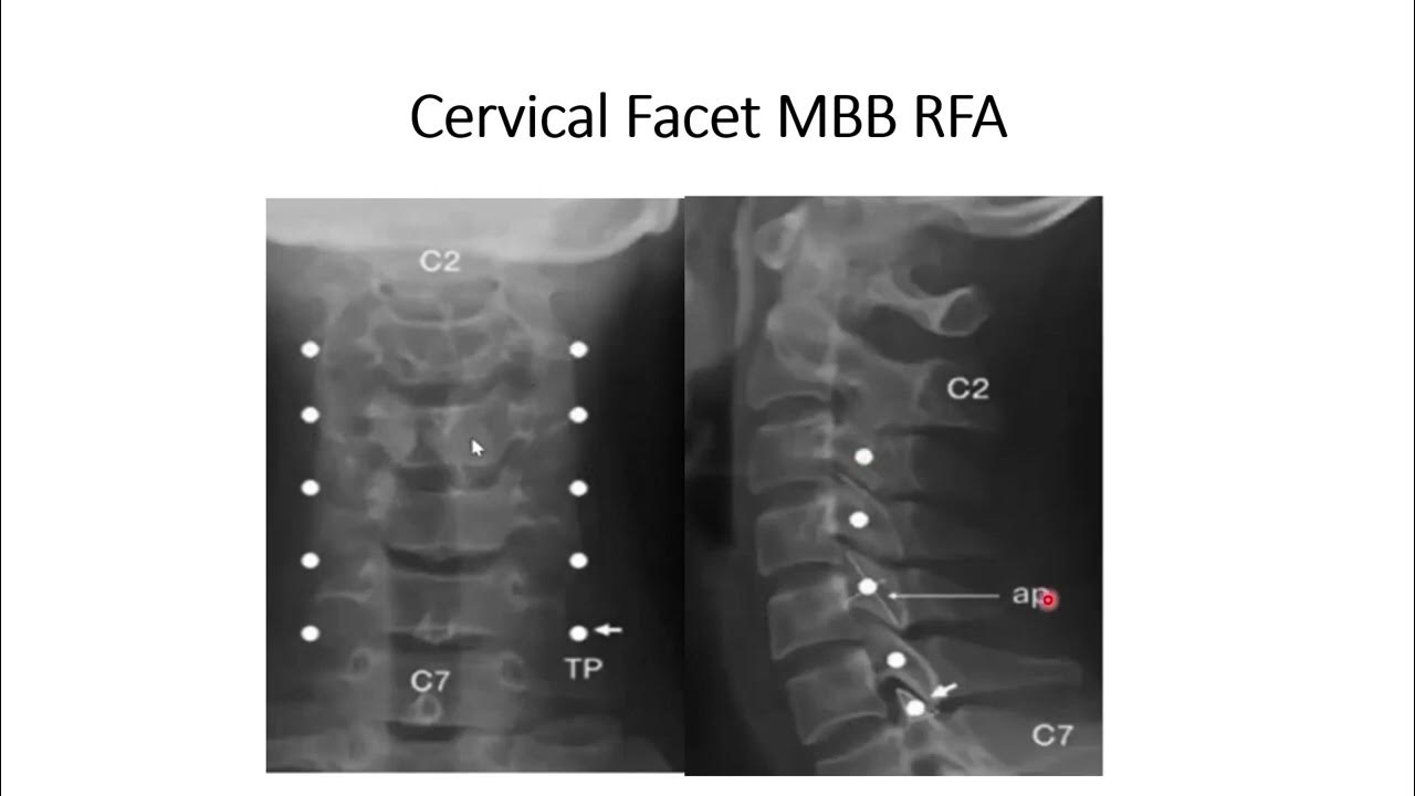Cervical Facet joint ( median branch) Radiofrequency ablation A