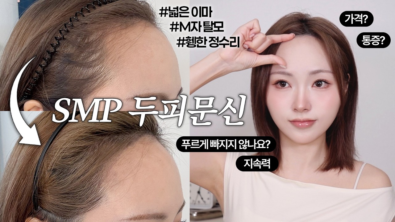 M자•넓은 이마 탈출‼️SMP 두피문신&헤어라인 컨설팅 꼼꼼후기 +Q&A까지! 지속력•가격•번짐,색빠짐•통증 등