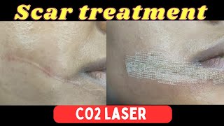 Laser treatment of scar| CO2 laser treatment for scar on face | By Dr.Pankaj Kumar (plastic surgeon)