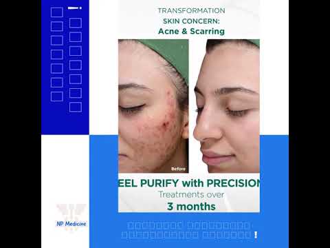 ქიმიური პილინგი !