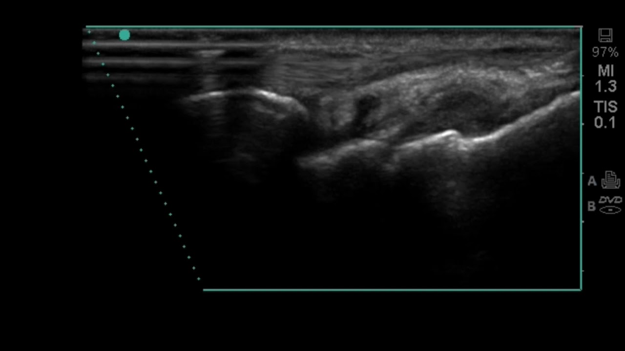 Wrist Ultrasound: Wrist Joint Injection (in plane)