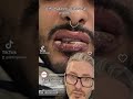 Lip filler complication ⚠️