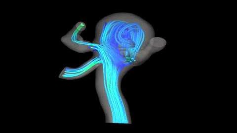Fluid-Structure Interaction Analysis of Arterial Blood Flow