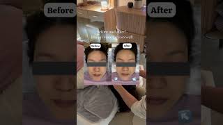 ✨ Japanese Face Alignment Therapy in Forestville | Ice Age Beauty Sydney ✨