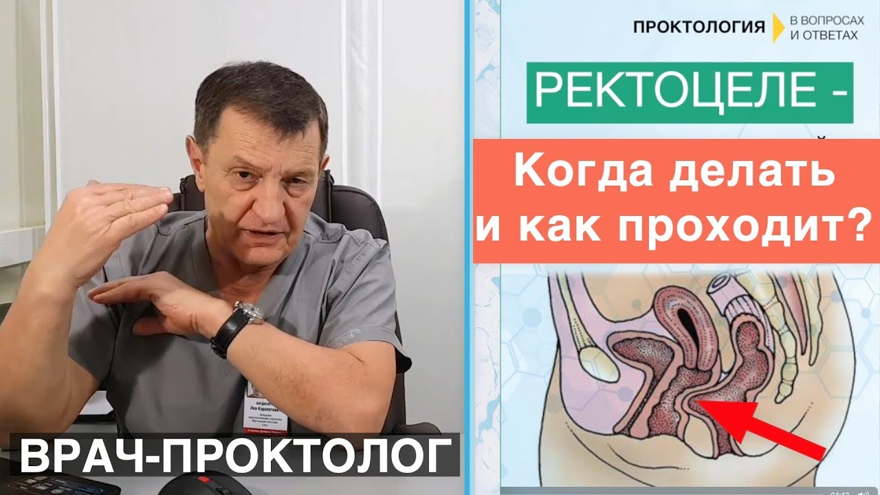 Сова проктолог. Лев Карапетович проктолог. Проктология- ректоцеле. Лев Багдасарян проктолог.