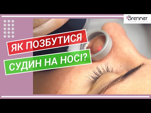 Удаление сосудов на носу лазером | Лазерное удаление купероза на лице | Клиника доктора Бреннера