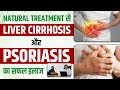 Natural Treatment से हुआ Liver Cirrhosis और Psoriasis का इलाज सफल | Patient Success Story | SRIAAS