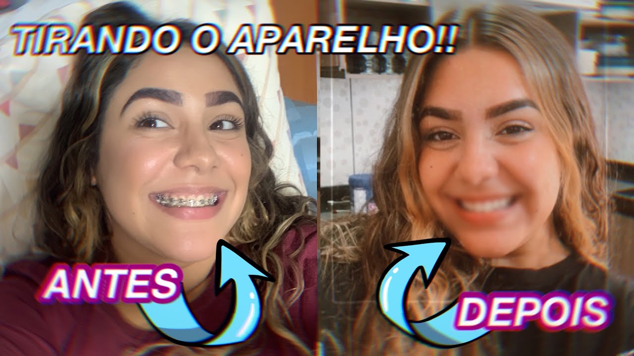 ~VLOG~ Tirando o aparelho Ortodôntico | Juu Emanuele ♡