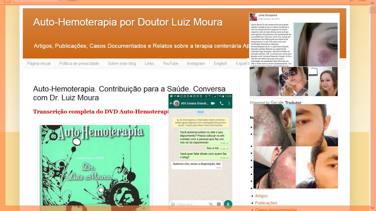 Autohemoterapia cura Fogo Selvagem. 3 casos de cura de Pênfigo Foliáceo. YouTube Autohemoterapia cura Fogo Selvagem. 3 casos de cura de Pênfigo Foliáceo. YouTube