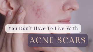 You Don’t Have to Live With Acne Scars!